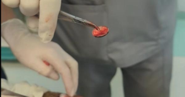 Хірурги витягнули з руки пораненого бійця европейську монету